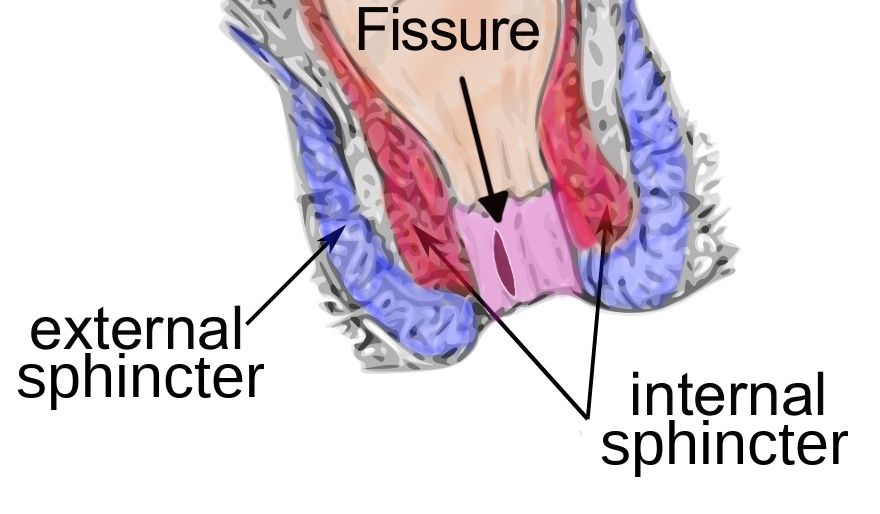Causes of anal fissures